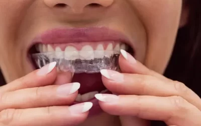 Invisalign Carson: Clear Aligner Therapy for Discreet Orthodontic Correction